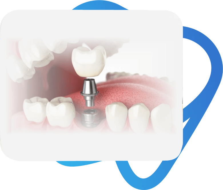 Implante dentário em sapopemba (1)